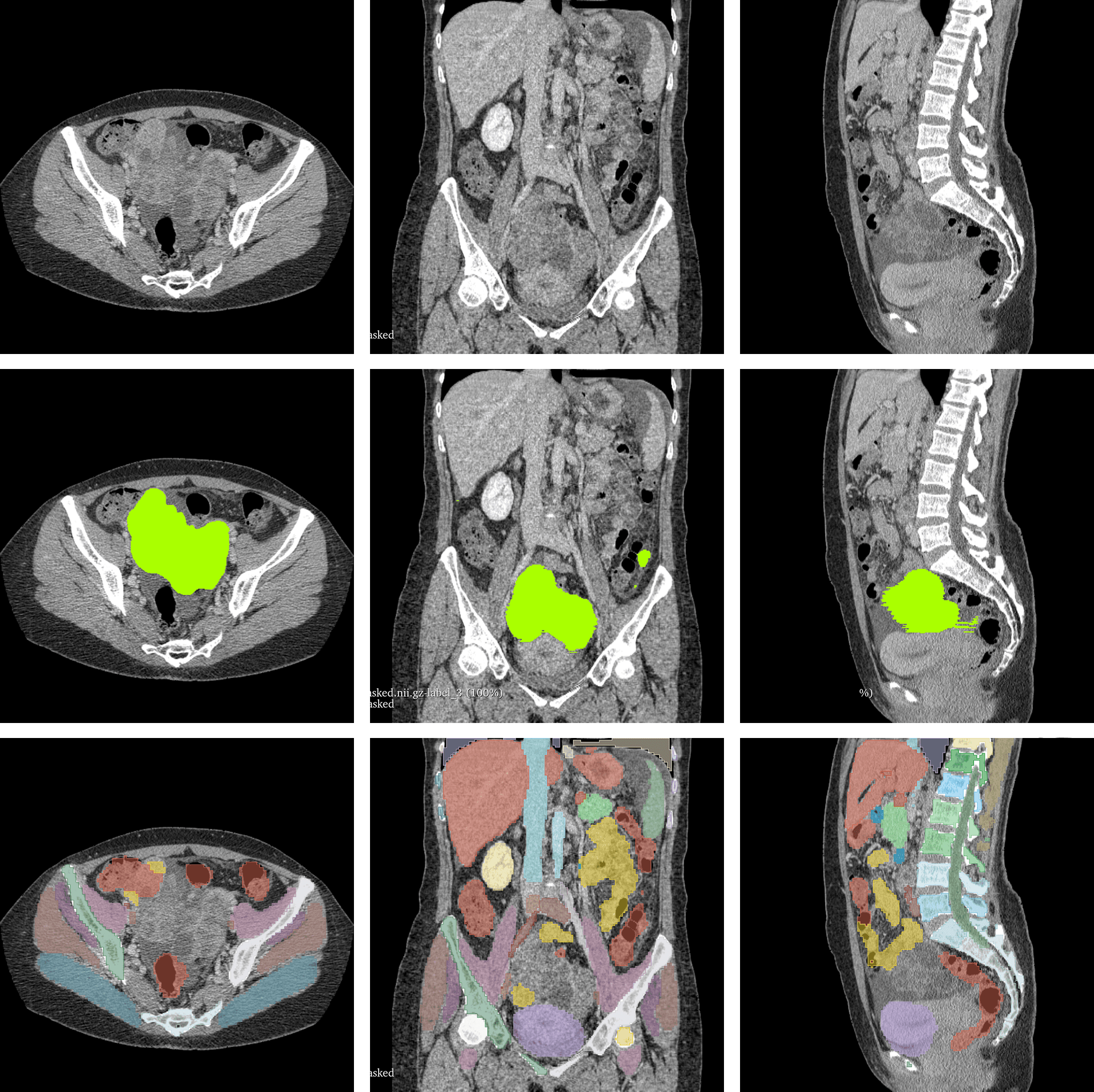 Tumor & multi-organ segmentation